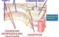 Растяжение грудных мышц