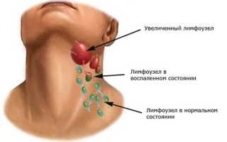 Воспаление лимфоузлов под челюстью