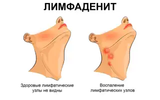 Острый лимфаденит: причины, симптомы и лечение