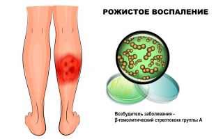 Особенности течения рожистого воспаления