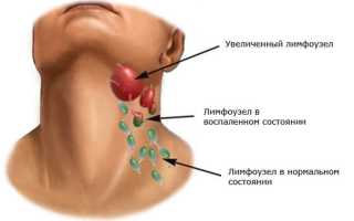Регионарные лимфоузлы: причины увеличения и диагностика