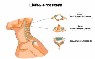 Шейные боли при повороте головы