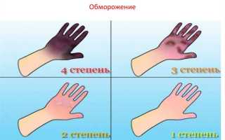 Как лечить обморожение четвертой степени