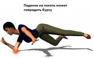 Локтевой бурсит