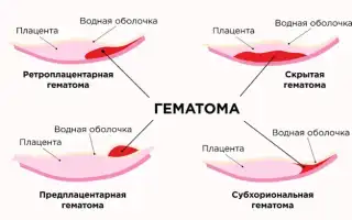 Особенности и лечение кровянистых выделений