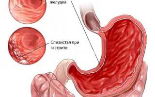 Черный кал: причины и лечение