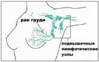 Осложнения после лимфаденэктомии подмышечных лимфоузлов