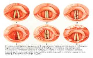 Понятие туберкулеза гортани, трахеи и бронхов