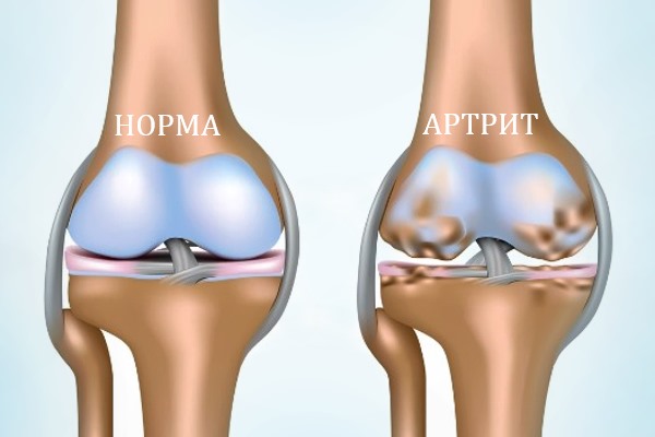 Артрит коленного сустава