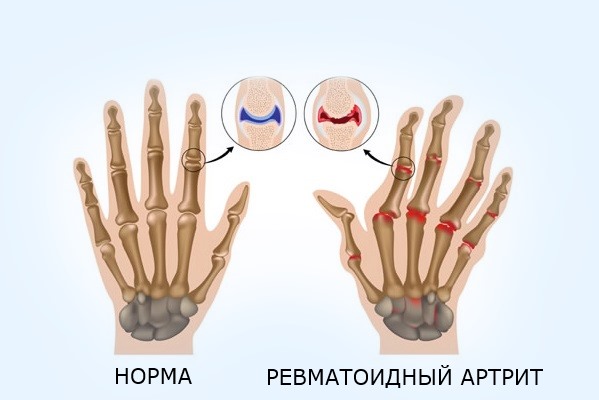 Артрит пальцев