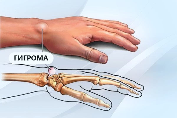 Гигрома на руке