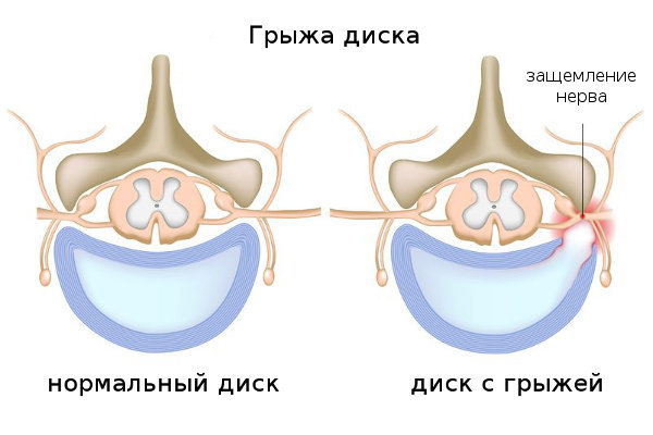 грыжа диска схема