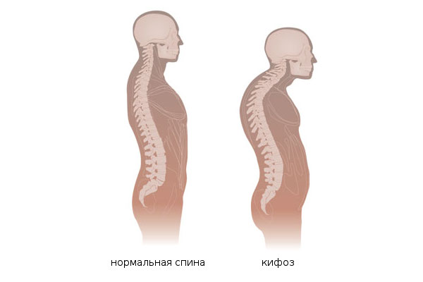 кифоз