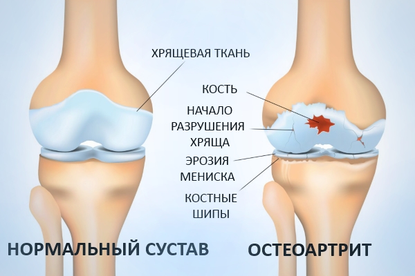 Остеоартрит