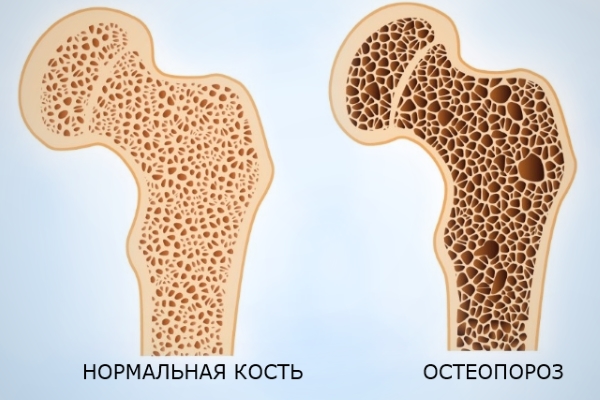 Остеопороз костей