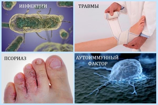 Причины артрита стоп