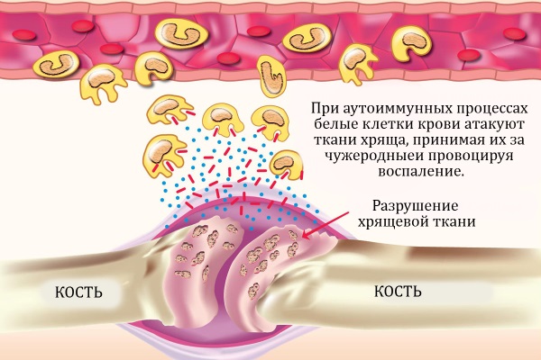 Воспаление хрящевой ткани сустава