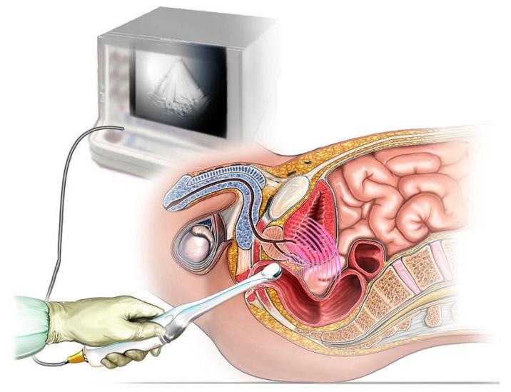Аппрат УЗИ в анусе