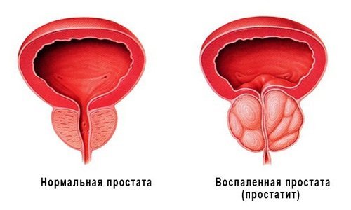 Нормальна и воспаленная простата