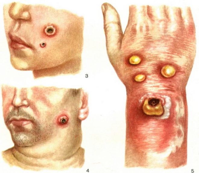 Сибирская язва