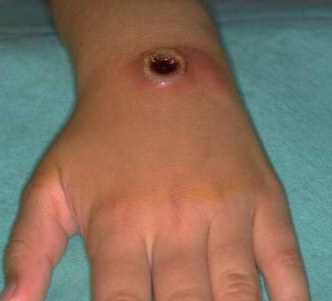 Эдематозное течение