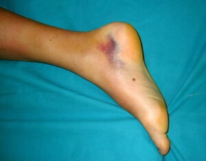 Синяк Травма