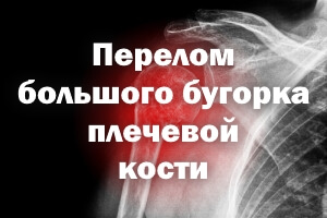 Сломан большой бугорок плечевой кости Перелом большого бугорка плечевой кости