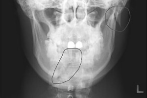 Травма Повреждение