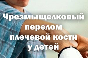Чрезмыщелковый перелом плеча у детей Чрезмыщелковый перелом плечевой кости у детей