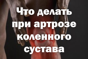 Что делать при артрозе коленного сустава, как избежать боли Что делать при артрозе коленки, как избежать боли