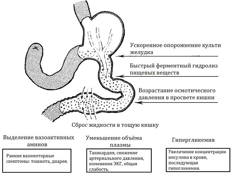 Демпинг-синдром Демпинг реакция