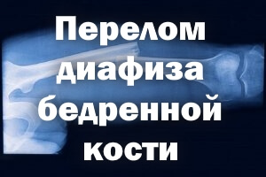 Перелом диафиза бедра Перелом диафиза бедренной кости