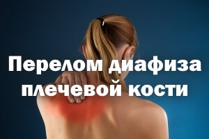 Перелом диафиза плеча Перелом диафиза плечевой кости