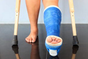 Гипс на ноге Нога в гипсе