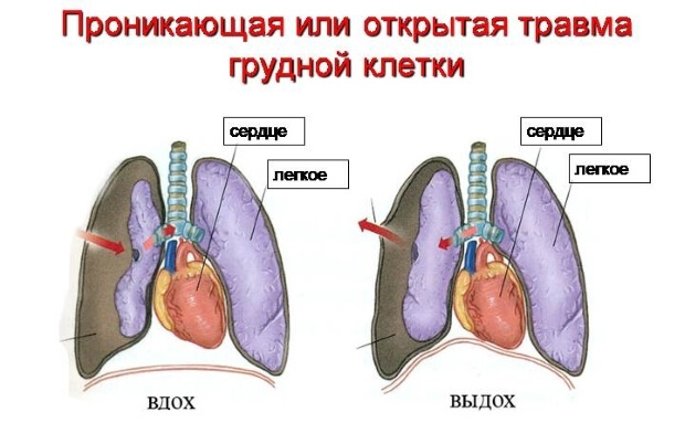 Травма Открытое