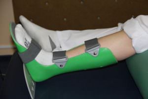 Иммобилизация кости