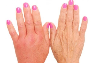 Отеки Опухли