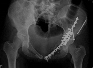 Эффективное лечение Рентген снимок