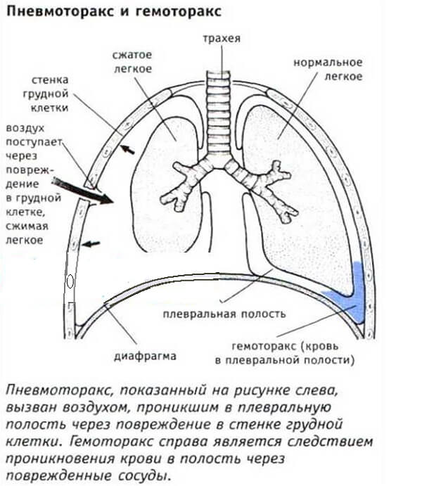 Средство Пневматорокс