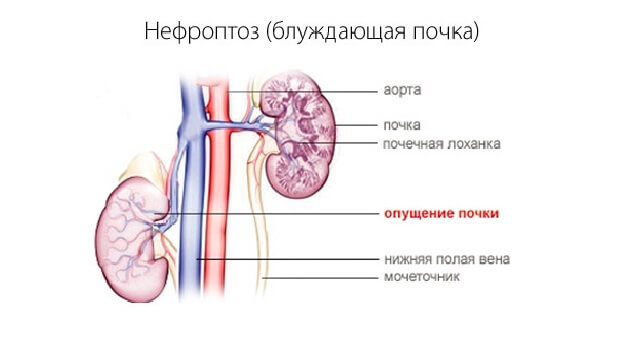 Нефроптоз Болезнь нефроптоз