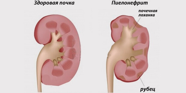 Пиелонефрит Как лечить пиелонефрит