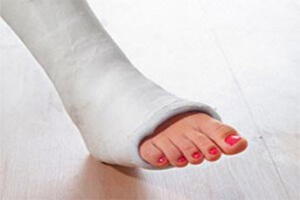 Гипс Наложение гипса