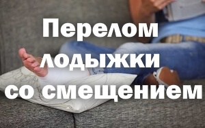 Реабилитация при переломе лодыжки со смещением Перелом лодыжки со смещением