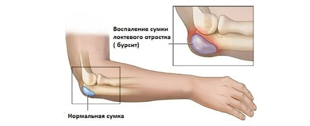 Бурсит Бурсит локтевого сустава