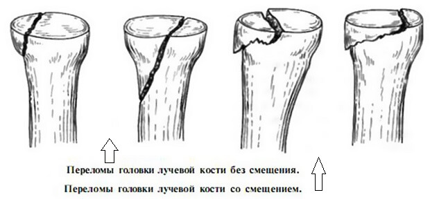 Поменять Виды переломов