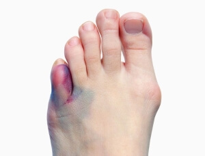 Поменять Сильный ушиб мизинца