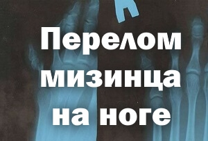 Сломан мизинец на ноге Перелом мизинца на ноге
