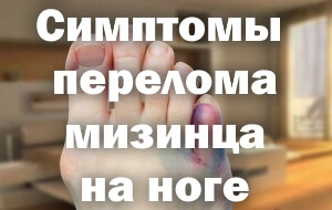 Симптомы сломанного мизинца на ноге Симптомы перелома мизинца на ноге