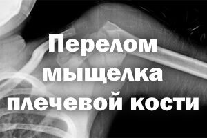 Перелом мыщелка плеча Перелом мыщелка плечевой кости