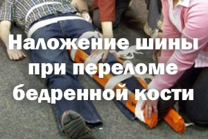 Наложение шины при переломе бедра Наложение шины при переломе бедренной кости
